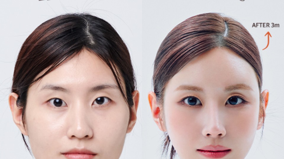디엘성형외과 리얼모델 모집